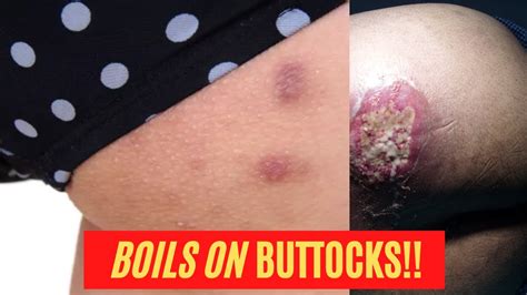 butt crack boils